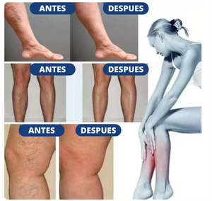 PARCHES PARA VARICES